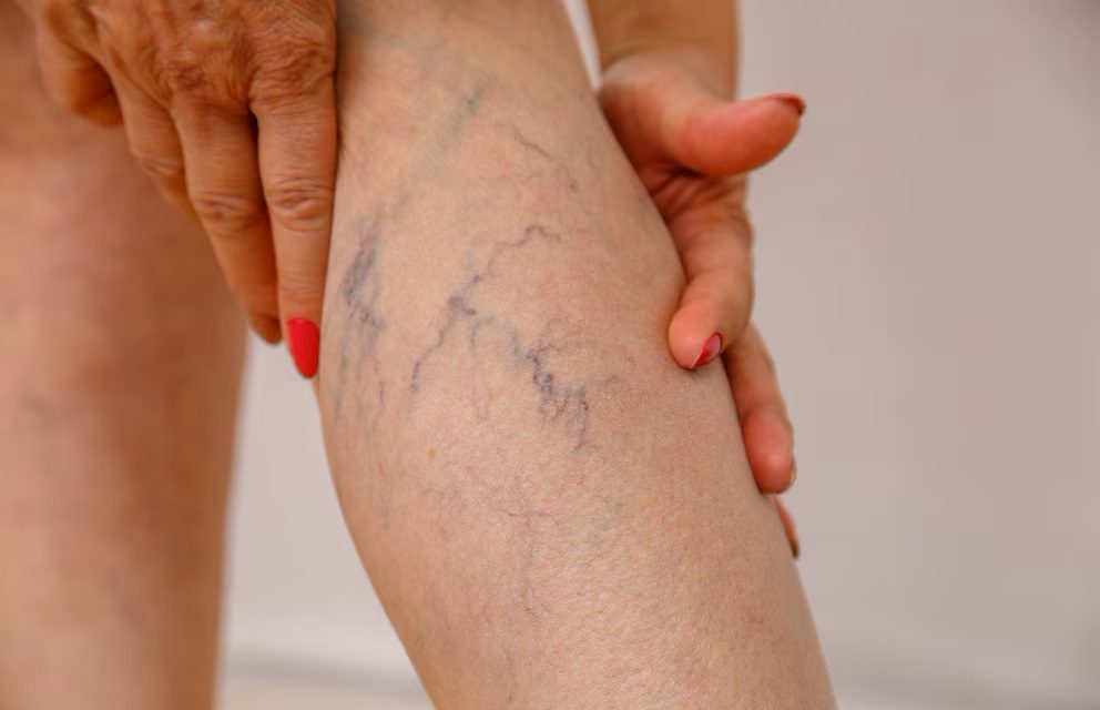 Biljka koja se učinkovito bori protiv varikoznih vena, višica i varikoznih vena na nogama, u skladu s nogama